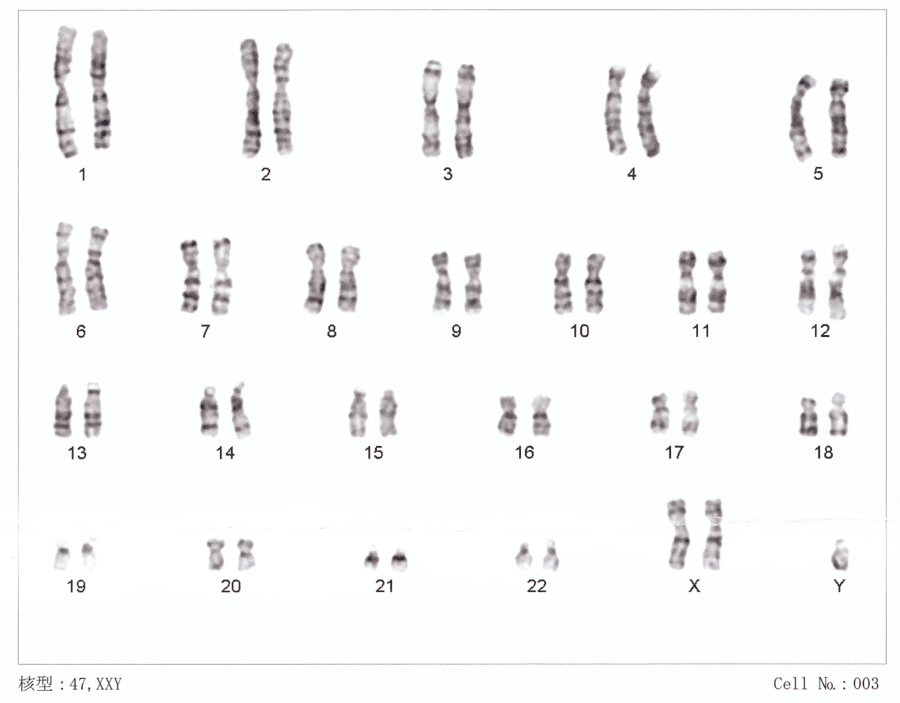 Karyotypes: Genetic Syndromes Identification